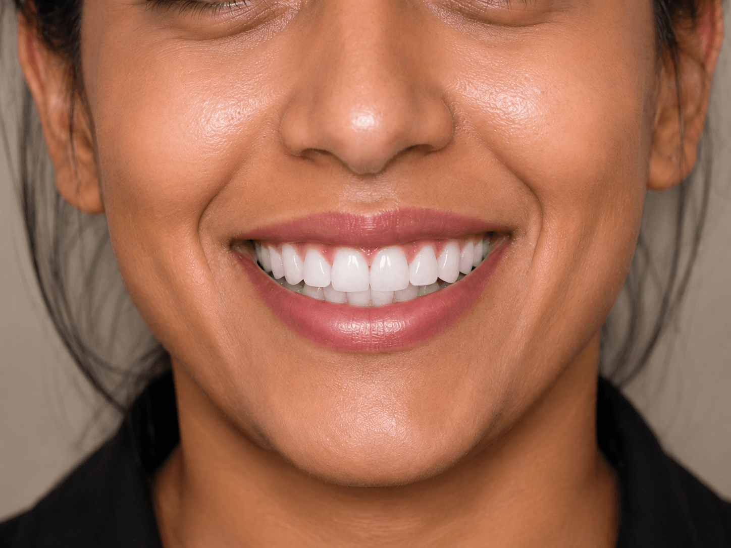 Veneers — after treatment